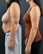 Before and after side-by-side comparison of a woman's torso, showing body contour changes. The left side shows a woman in a beige bra and a light blue patterned skirt, while the right side shows the same woman in a rust-brown tank top and black pants against a dark gray background.